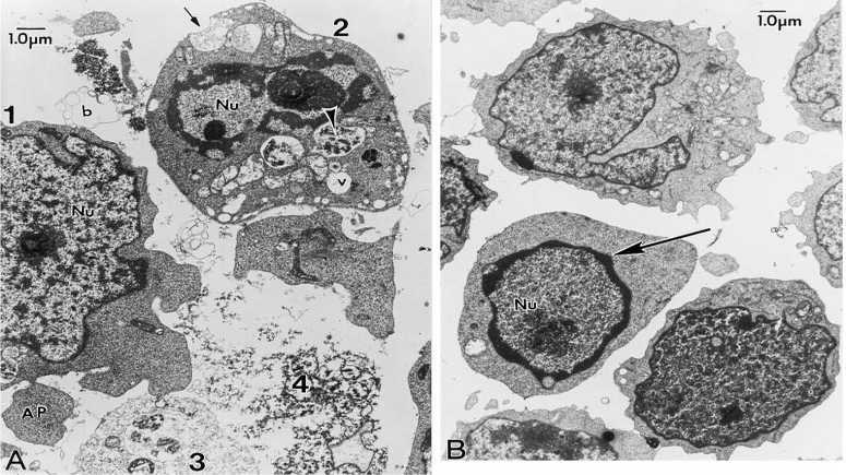 <p>The various phases of apoptotic body formation in chemotherapeutic agenttreated ALL-697 cells. (A) ALL-697 cells were treated with 10 M etoposide for 6 h. Various phases of the formation of apoptotic bodies are evident in this micrograph and are labeled 1-4. The cell labeled 1 is at an early stage and shows very minimal chromatin condensation in the nucleus (Nu), but an apoptotic body (AP) can be seen budding off and another is probably forming adjacent to it. The cell labeled 2 is at an intermediate stage and shows partially condensed chromatin in the nucleus, apoptotic body formation and many heterogeneous vesicles (V). The black and white arrowhead points to a vesicle with dense contents that suggests lysosomal origin. The small arrow points to one vesicle that appears poised to open and release to the extracellular space, which is full of membrane profiles and debris, characteristic of cells exposed to apoptotic inducers. The cells labeled 3 and 4 have completed apoptosis and are dispersing as granular debris (the ghost cell stage). This images clearly demonstrates that induction of apoptosis is asynchronous. (B) The typical morphological changes of the cells after 3 h treatment with 10 M etoposide. The arrow indicates the beginning of chromatin condensation at the periphery of the nucleus. Of note is that at the early phase of apoptotic body formation, there is not much accumulation of vesicles in the cells</p>